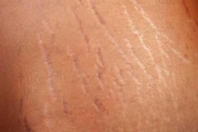 شایع‌ترین عوامل ترک‌‌های پوستی